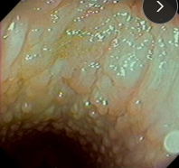 <p><span>Inflammatory Pharynx &amp; Larynx Conditions in Horses</span></p>