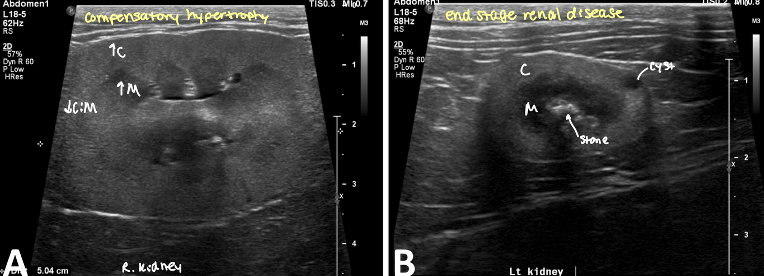 <p>compensatory hypertrophy</p><ul><li><p>kidney preserved architecture</p></li><li><p>decreased CM distinction</p></li></ul><p></p>