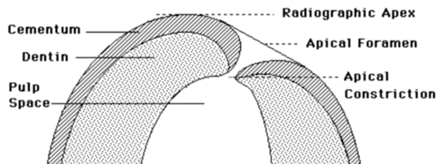 <p>Estimated Working Length (EWL) : Determined by subtracting _____from the radiographic length of the tooth.</p>