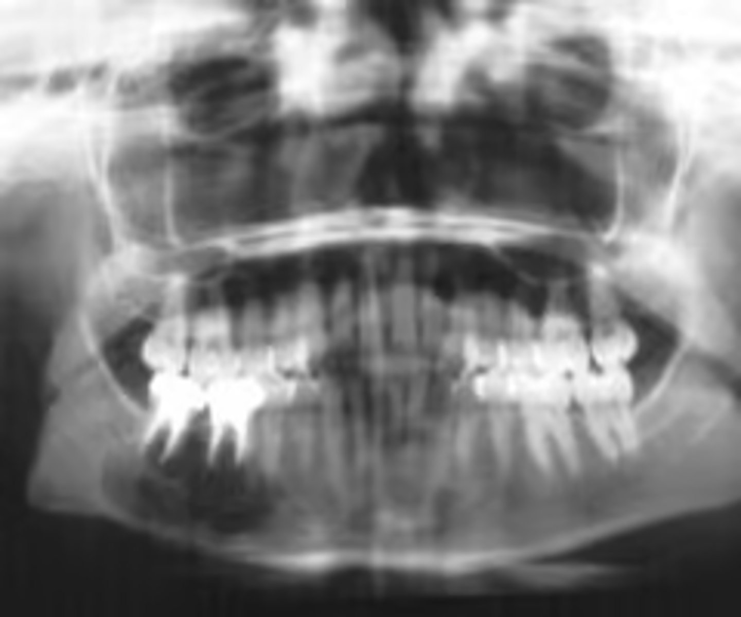 <p>ID the pathology:</p><p>- Reactive lesion</p><p>- CF: Common lesion, appro. 20 years of age, painless swelling and asymmetry</p><p>- RF: anterior mandible, secondary-anterior maxilla, can cross midline</p><p>- Well defined corticated or non-corticated borders</p><p>- Uni-or multilocular, completely radiolucent or wispy straight septae</p>