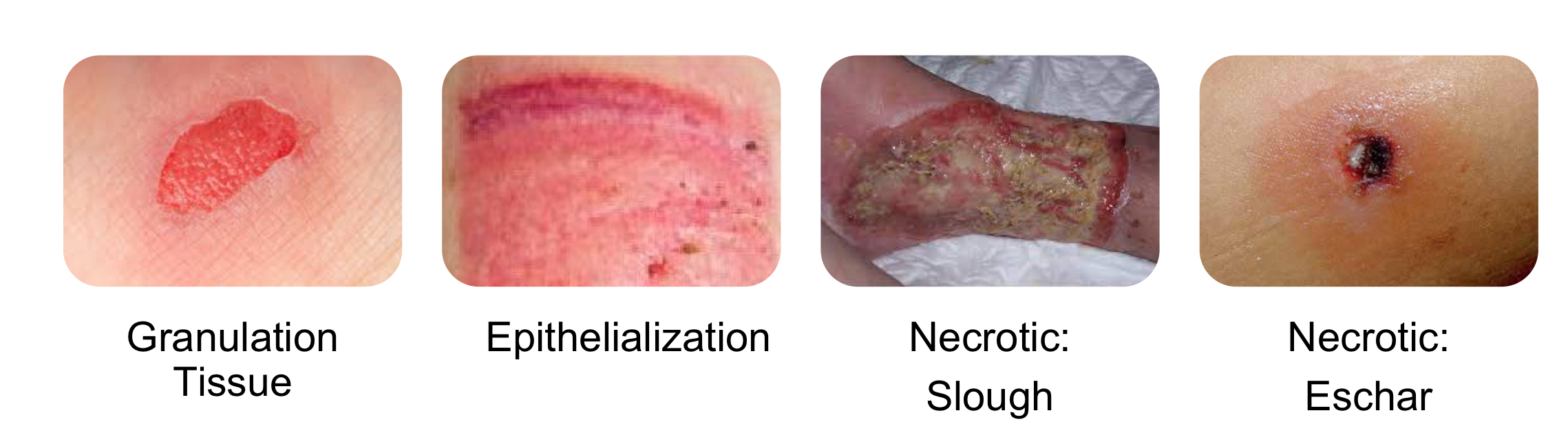 <ul><li><p>Granulation </p></li><li><p>Epithelialization </p></li><li><p>Necrotic slough</p></li><li><p>Necrotic eschar</p></li></ul><p></p>