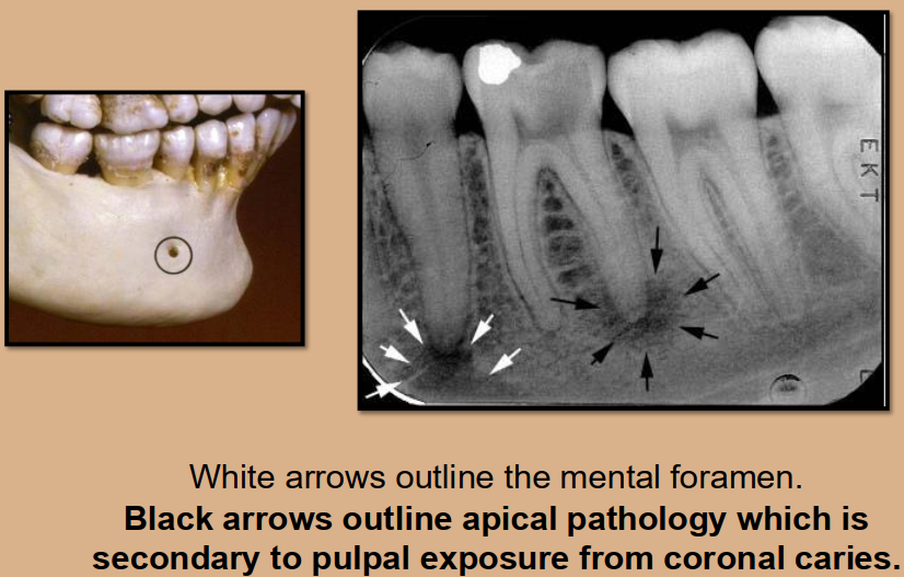<p>Mental foramen</p><ul><li><p>opening or hole in bone located by the mandibular premolar region</p></li><li><p><u>Radiography: small ovoid or round </u><strong><u>radiolucent area</u></strong><u> located in the apical region of the mand. premolars. </u></p><ul><li><p><strong><em>**frequently misdiagnosed as periapical lesion. → black arrows point to a real apical lesion </em></strong></p></li></ul></li></ul><p></p>