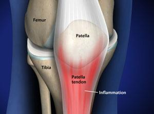 <p>A ligament that connects the patella to the tibia, providing stability to the knee joint. </p>