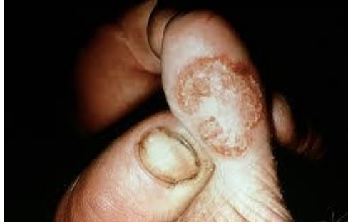 <p>What scabs appear in pseudocowpox on the teats, muzzles, and mouths of suckling calves?</p>