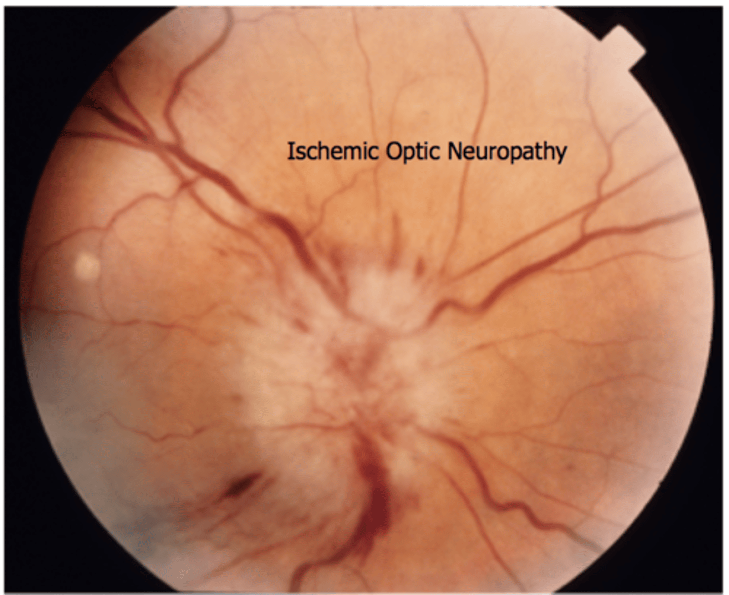 <p>results from <strong>nonperfusion/hypoperfusion</strong> of the ciliary blood supply to the optic nerve head.</p><p></p><p>nonatheritic AION can cause <strong>altitudinal vision field loss</strong>.</p>