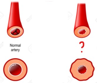 <p>The artery on the left is affected by vaso(dilation/constriction).</p>