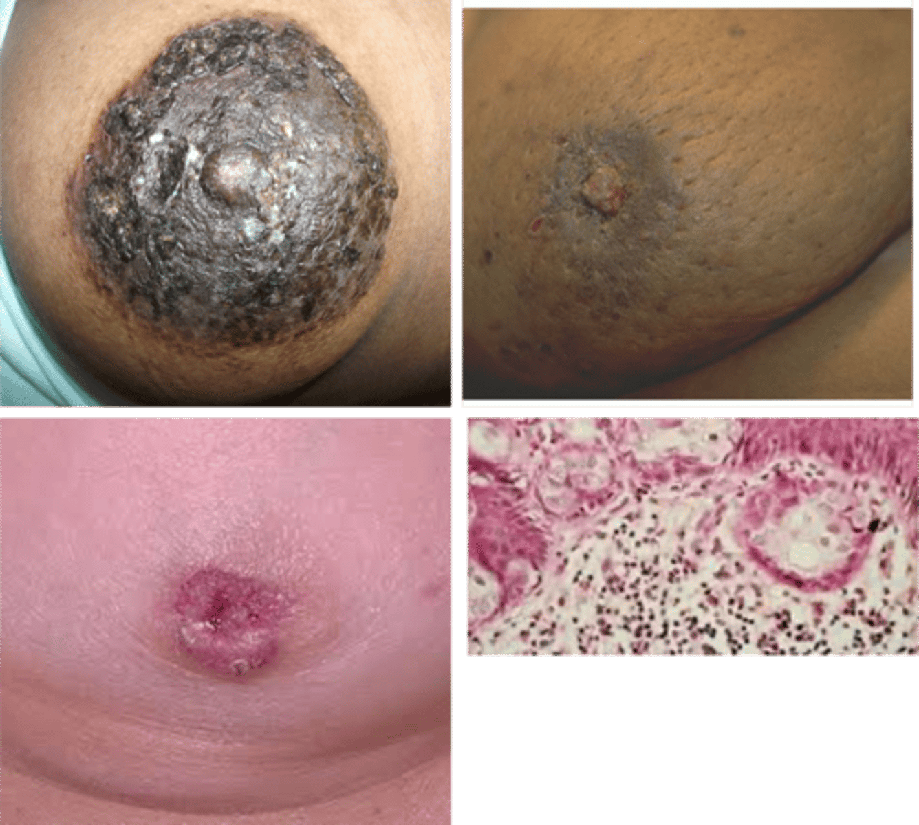 <p>Define Breast Cancer:</p><p>Extension of DCIS/invasive breast cancer up the laciferous ducts and into contiguous skin of nipple --&gt; eczematous patches over nipple/areolar skin</p><p>-Hx: 3% of breast cancer</p><p>-Path: NONInvasive</p><p>-Sx/PE: 2/3 of PALPABLE mass</p><p>-Dx: Intraepithelial adenocarcinoma cells</p>