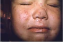 <p>Varicella Zoster (Chickenpox)</p>