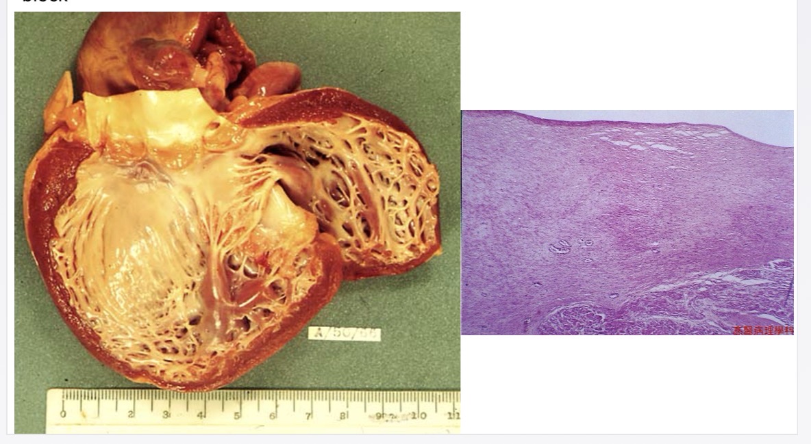 <p>myocardial lymph drainage defect → chronic oedema, fibroelastic tissue proliferation → (restricted output → CHF)/ (incarcerate purkinje fibres → L bundle branch block)</p>