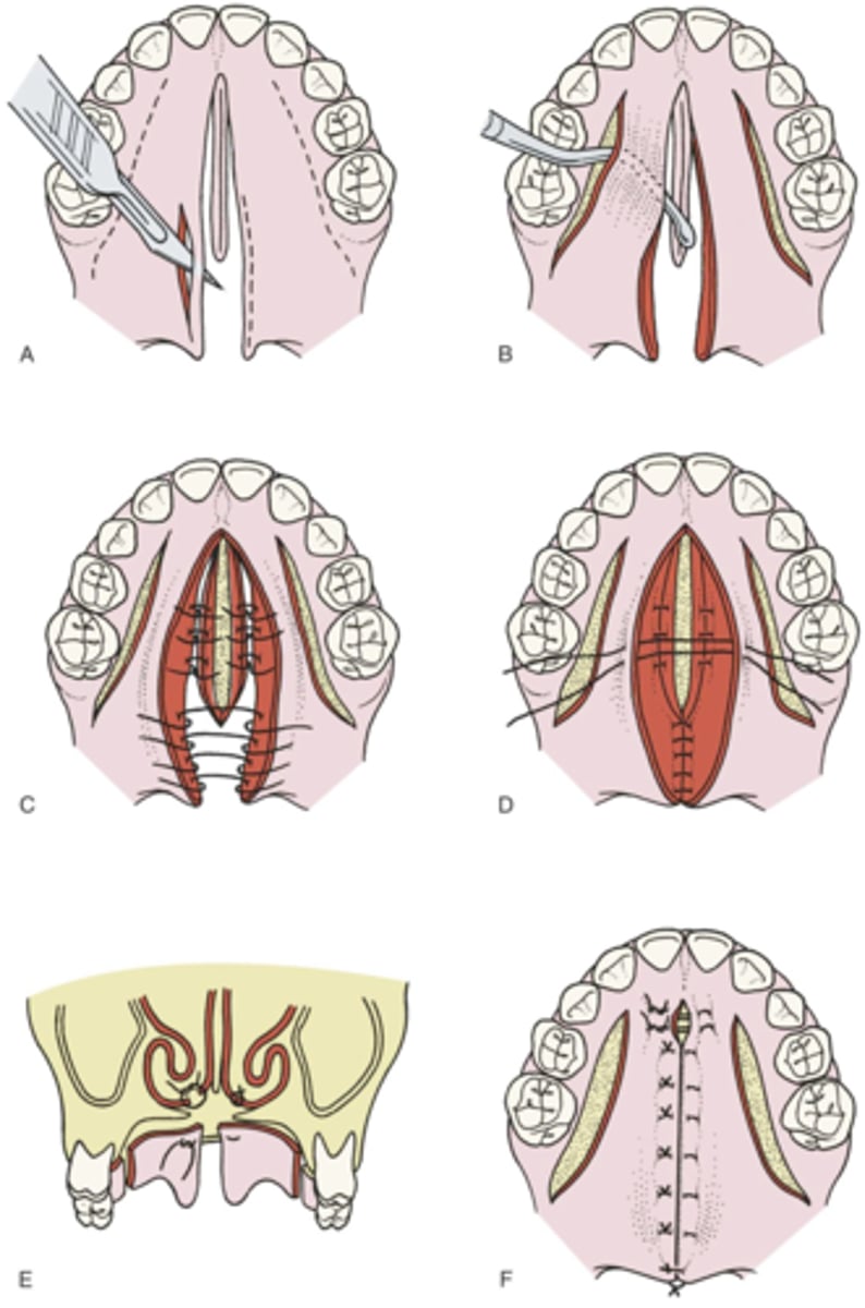 <p>which palatorrapphy method:</p><p>- operation for concomitant hard and soft palate closure.</p><p>- three-layer closure for the soft palate</p><p>- two-layer closure for the hard palate</p>
