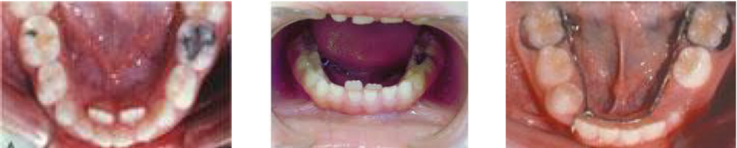 <p>Changes normal tooth eruption pathway </p><p>Improve the positions and extract temp tooth</p>
