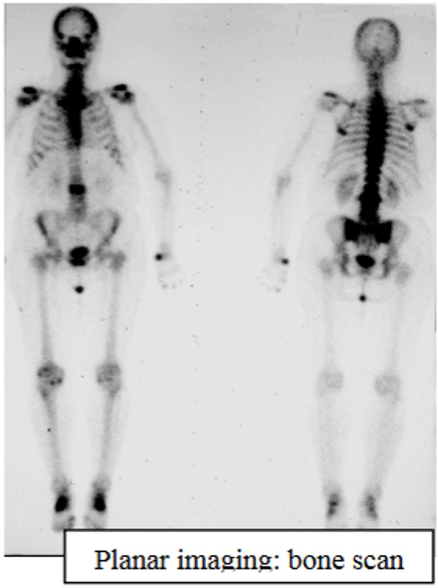 <p>Bone scan.</p>