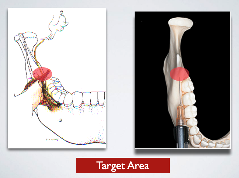 <p>target area of which nerve block?</p>