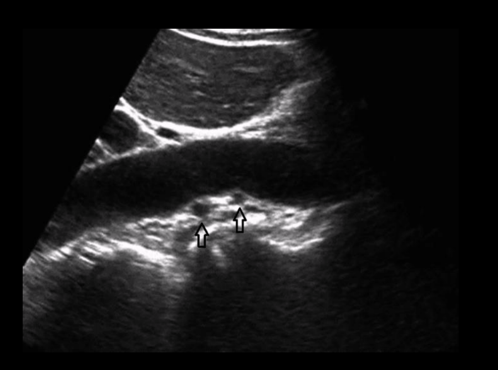 <ul><li><p>Often arises from aorta below main renal artery</p></li><li><p>Course to polar surfaces of kidney</p></li></ul><p></p>