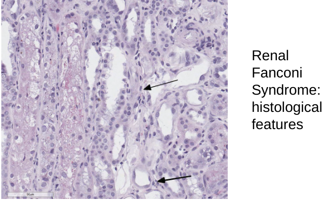 <ul><li><p>squamous Cells, nuclei are distorted, microvilli are reduced in number and length</p></li><li><p>basement membrane becomes wrinkled and thickened</p></li></ul><p></p>