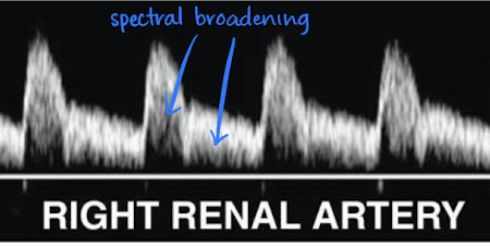 <ul><li><p><u>low resistant</u> waveform (sharp brisk upstroke; significant diastolic flow)</p></li><li><p>had <u>spectral broadening</u></p></li></ul><p></p>