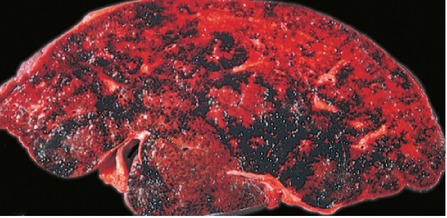 <p>Budd-Chiari Syndrome (posthepatic venous thrombosis, can be related to Polycythemia vera)</p>