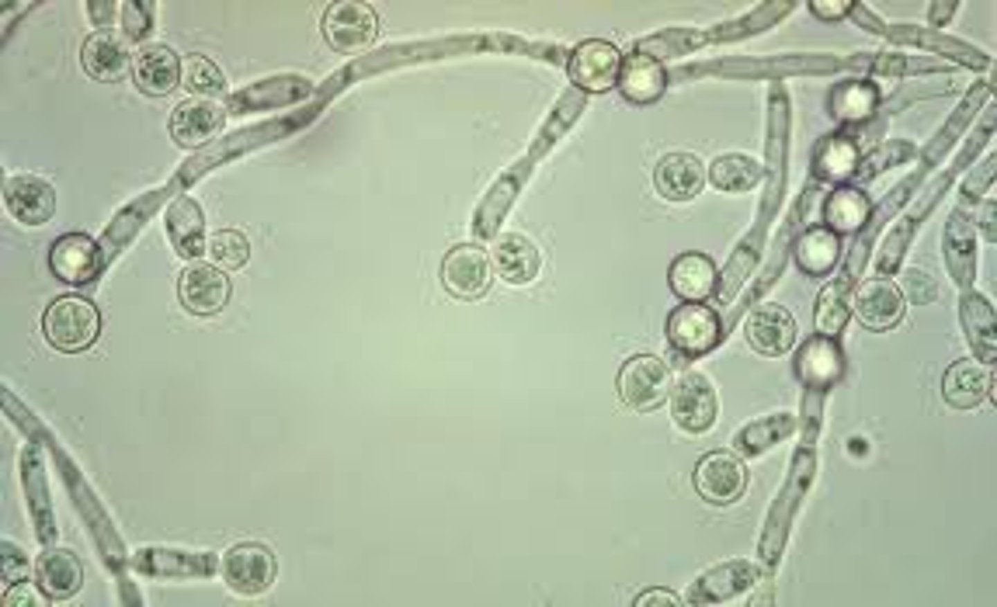 <p>small, oval, refractile structures with buds or mycelia</p><p>-sources of error= rbc</p><p>-reported as= rare, few, moderate, or many per hpf</p><p>-correlations= LE, Glucose, WBCs</p>