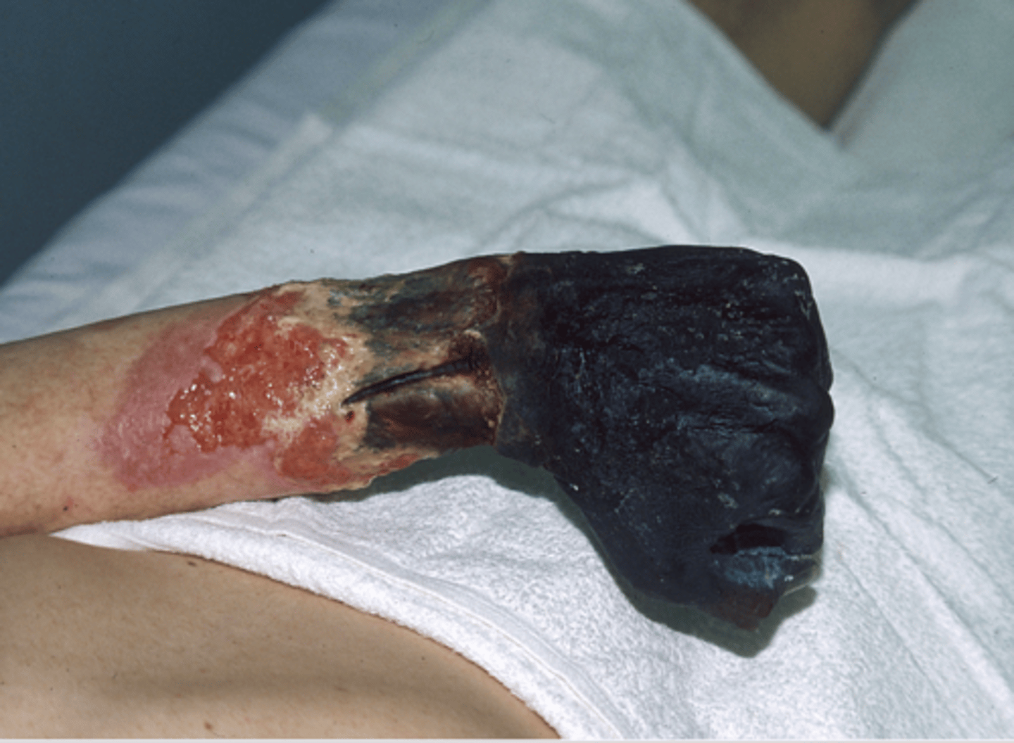 <p>typically coagulative necrosis involving multiple tissue planes</p><p>think wet gangrene - liquafactive</p>