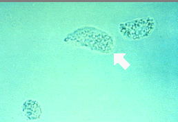 <p>Identify the urine sediment element shown:</p>