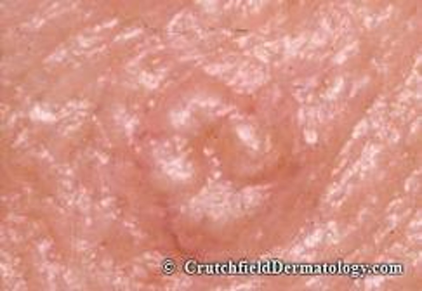 <p>Which benign epithelial lesion:</p><p>• Non-tender papules</p><p>• Yellow, white or skin-colored</p><p>• Slow growing</p><p>• Central umbilication</p>