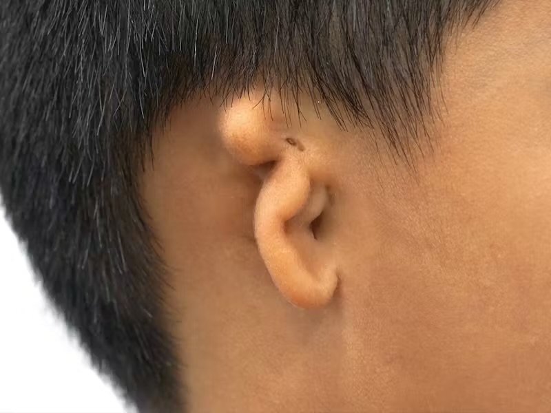 <p>small pinna, with or without landmarks</p><p>Congenital, may be associated with a syndrome</p><p><span style="background-color: transparent;">Treatment: Possible surgical reconstruction; amplification if indicated</span></p>