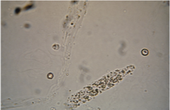 <ul><li><p><span>RTE lysosomes, excreted in normal metabolism, more after exercise and activity</span></p></li></ul><ul><li><p><span>Disintegration of cellular casts and free cells</span></p></li></ul><p></p>