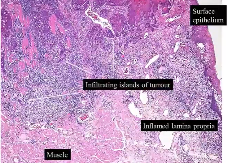 <ul><li><p>notice the infiltrating islands of cells that extend from the surface epithelium on the top right </p></li><li><p>they’re entering and breaking up the muscle layers - which still remain quite bright pink </p></li><li><p>lots of associated inflammation </p></li><li><p>the tumour islands do bear some resemblance to the surface squamous epithelium - but more chaotic version of it </p></li><li><p></p></li></ul><p></p>