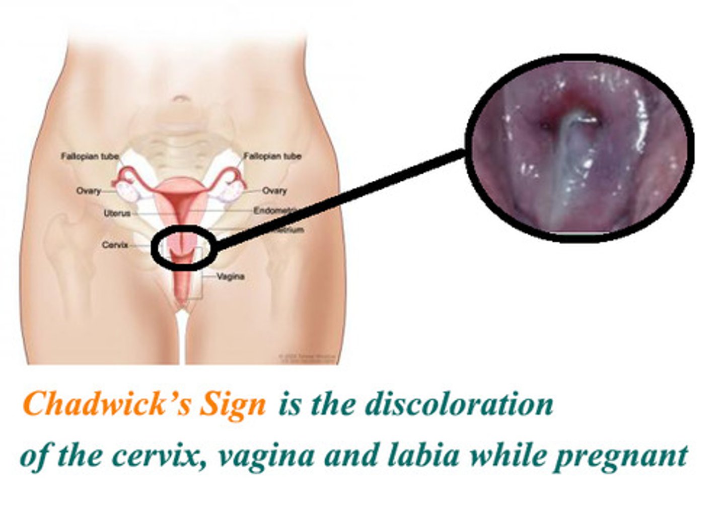 <p>cervical color change to cyanosis</p>