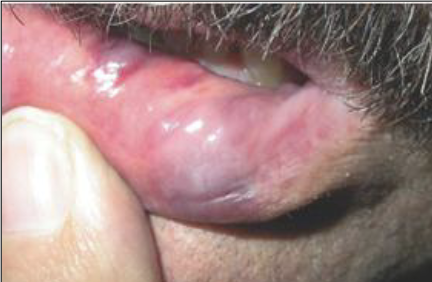 <p>Amyloidosis</p>