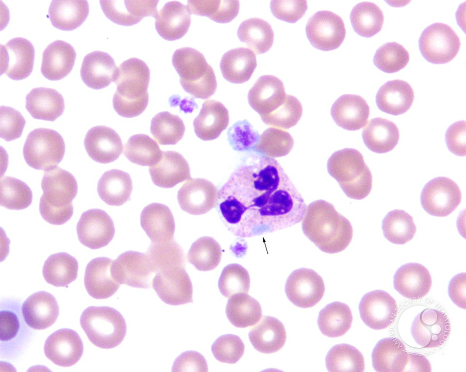 <p>What <strong>ribosomal RNA</strong> inclusions found in <strong>neutrohils, lymphs, monos, and platelets </strong>are seen due to genetic mutations?</p>
