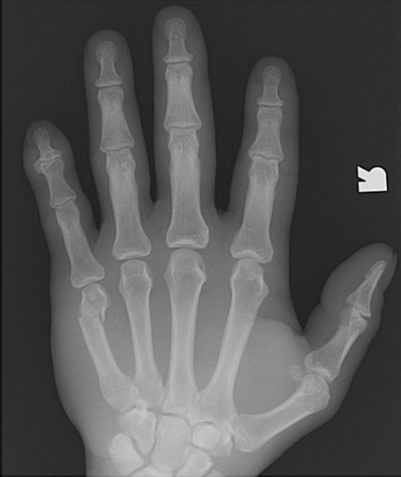 <p>Which fracture is this?</p>