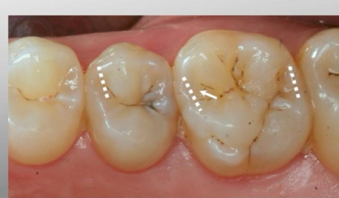 <p>On posterior teeth these ridges are on the mesial and distal borders of the occlusal surface.</p>