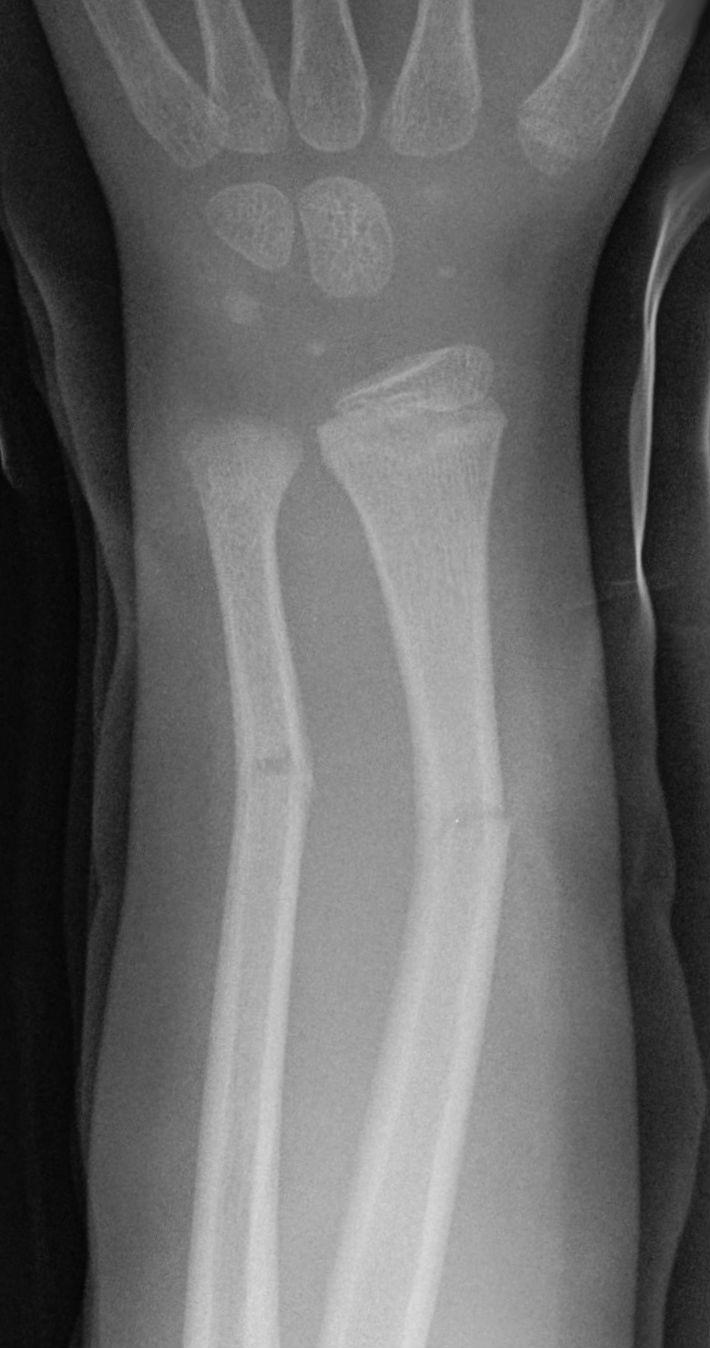 <p>Greenstick Fracture</p><p>comprises a bend in the bone on one side and a visible break in the bone cortex on the other side, which is incomplete</p><p>due to the pliable nature of bones in children, complete fractures are less common</p>