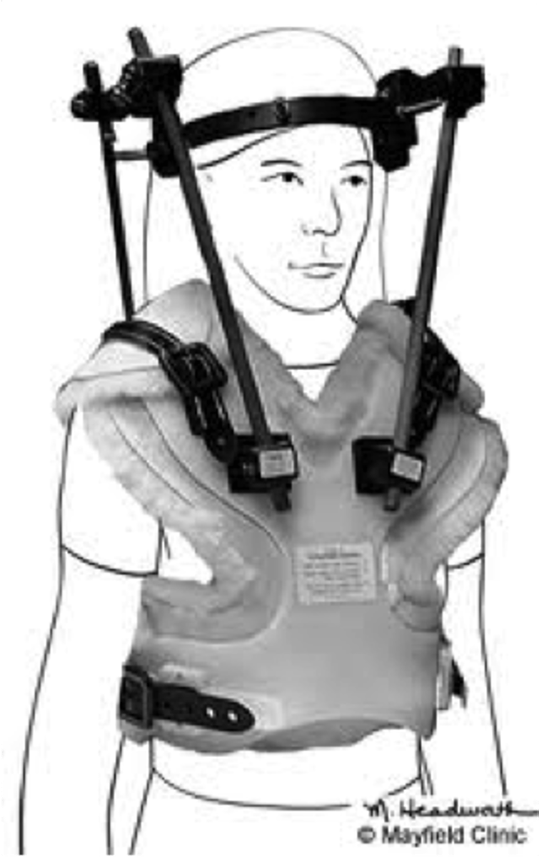 <p>halo vest</p>