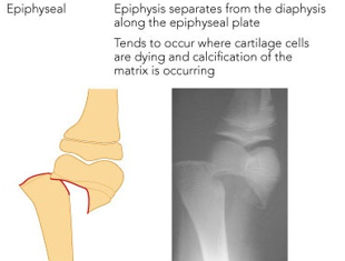 <ul><li><p>only happens in long bone </p></li><li><p>when epiphysis separates from the diaphysis along the epiphyseal plate </p></li></ul>