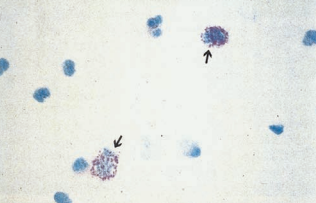 Eosinophils with Hansel stain