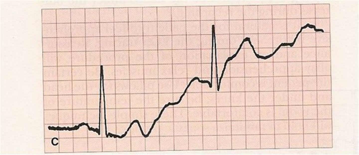 <p>Wandering baseline</p>