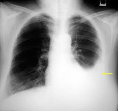 <p><strong>A nurse is providing care for a patient who has been admitted with a newly diagnosed bilateral pleural effusion. Which of the following findings from the nurse's initial assessment of the patient is incongruent with the patient's diagnosis and would require further investigation?</strong></p><p>A) The client complains of sharp pain exacerbated by deep inspiration.</p><p>B) The client's breath sounds are diminished on auscultation.</p><p>C) Pulse oximetry indicates that the client is hypoxemic.</p><p>D) The client complains of dyspnea and increased work of</p><p>breathing. </p>