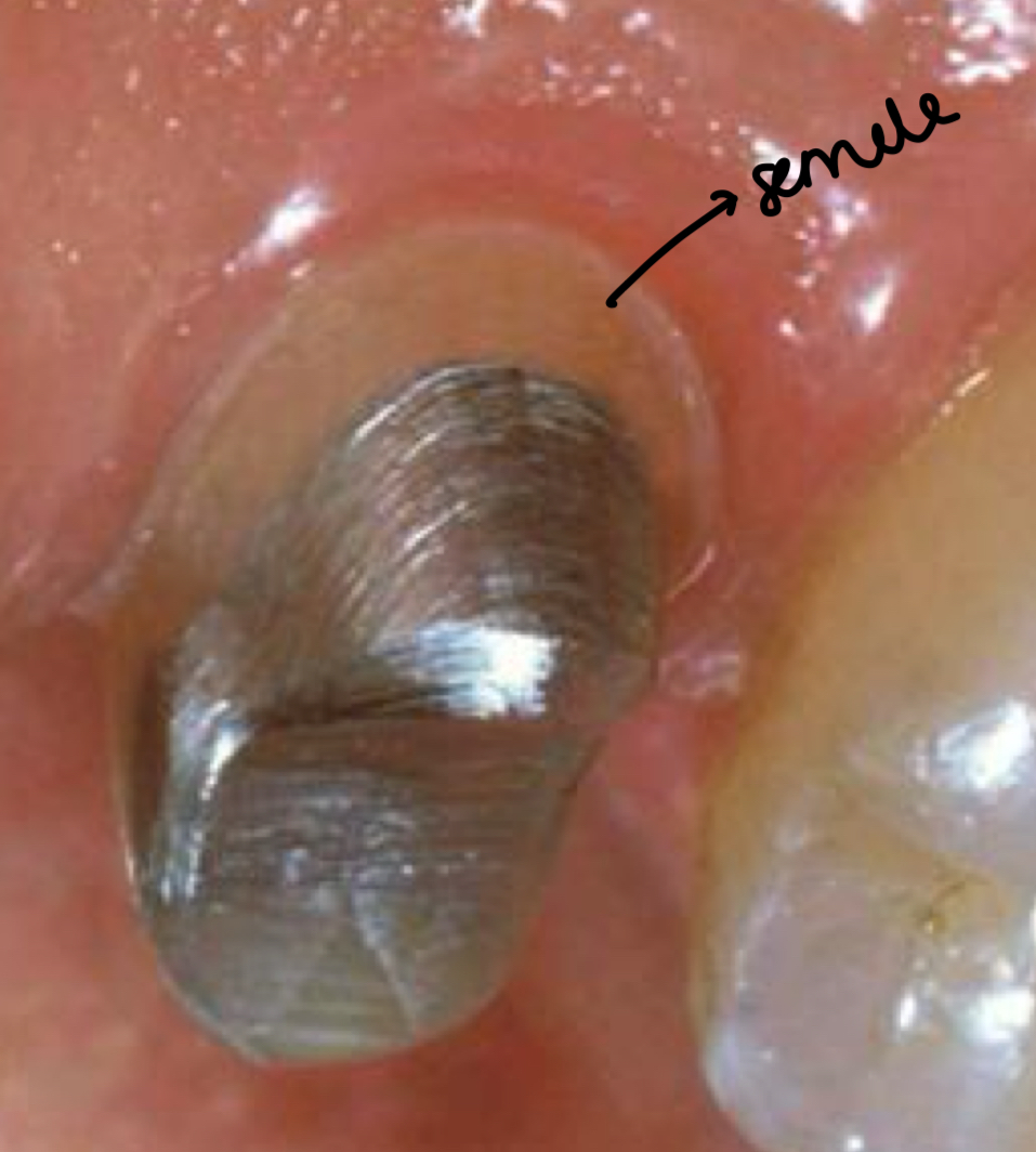 <p>X ray</p><p>Correct RCT </p><p>Good apical sealing </p><p>No radiolucent lesions </p><p><strong>2mm of supragingival ferrule </strong></p><p>If bone crest is below post due to bone loss<strong>- no resto </strong></p>