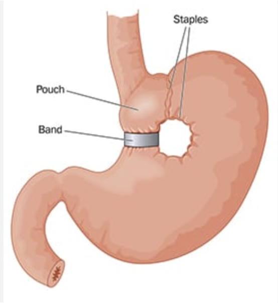 <p>Vertical banded gastroplasty</p>