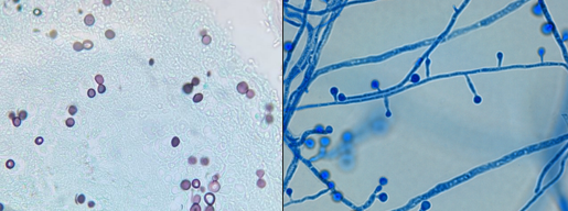 <p><span style="font-family: &quot;Times New Roman&quot;, serif; line-height: 107%;"><span>Clinical application: histology of canine with pneumonia, but can be in lungs (transtracheal aspirates), skin (exudates/aspirates), and brain (CSF)</span></span></p><p class="MsoListParagraphCxSpMiddle"><span style="font-family: &quot;Times New Roman&quot;, serif; line-height: 107%;"><span>Has two forms – mould or yeast (aka thermally dimorphic fungi)</span></span></p><p class="MsoListParagraphCxSpMiddle"><span style="font-family: &quot;Times New Roman&quot;, serif; line-height: 107%;"><span>Mould form (25C): septate hyphae</span></span></p><p class="MsoListParagraphCxSpLast"><span style="font-family: &quot;Times New Roman&quot;, serif; line-height: 107%;"><span>Yeast/spherule form (37C): large yeasts, thick wall, broad-based budding</span></span></p>