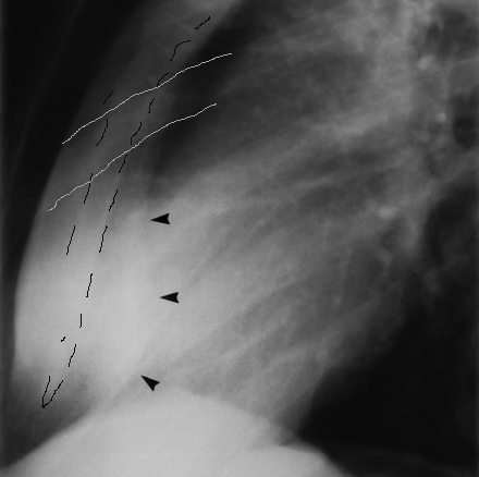 <p>Yes, Rotation. Anterior ribs SI across the sternum</p>