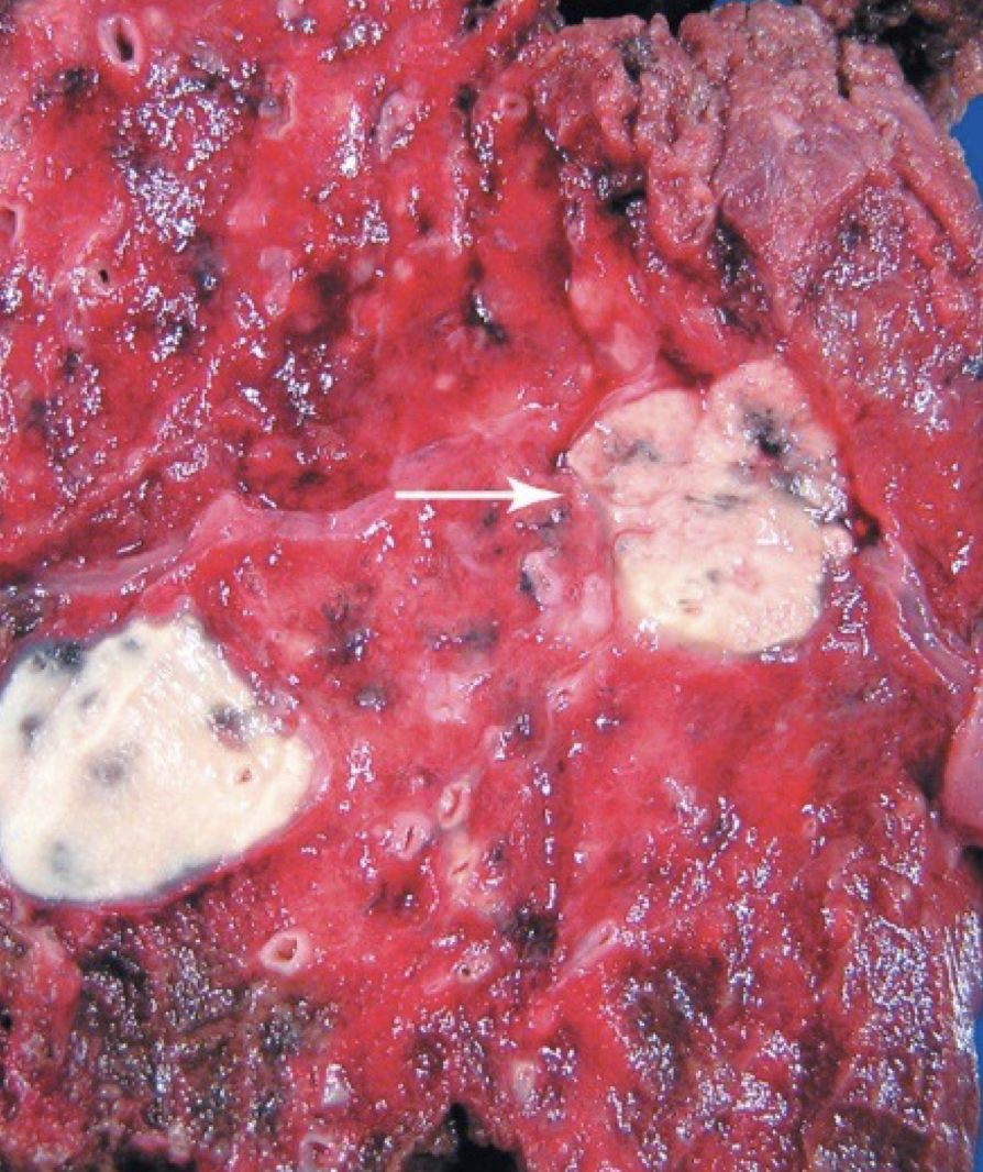 <p></p><ul><li><p>hard , round nodule or growth</p></li><li><p>In initial TB infection, are granulomas consisting of a central core containing bacilli surrounded by WBCs</p></li></ul>