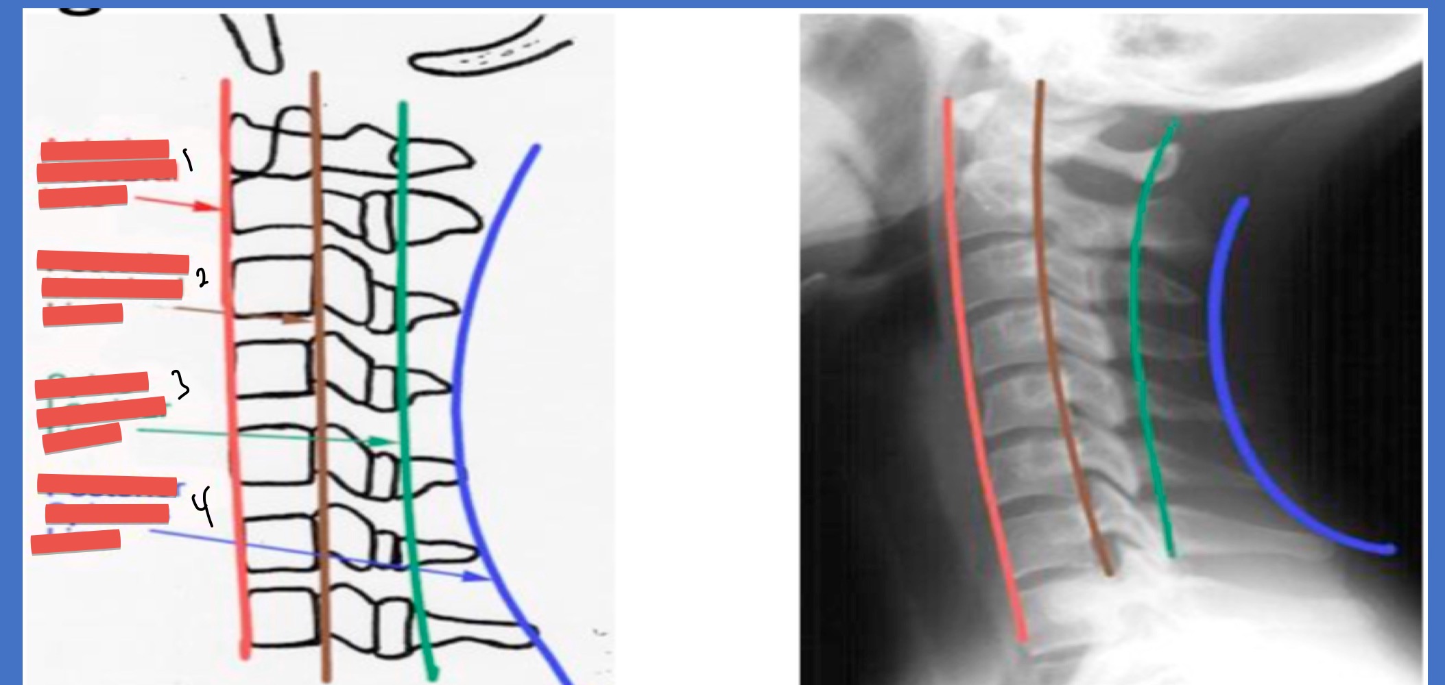 <ol><li><p>Ant vertebral line</p></li><li><p>post. vertebral line</p></li><li><p>spino-laminar line</p></li><li><p>post. spinous line</p></li></ol><p></p>