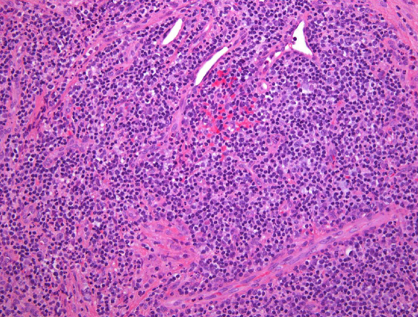 <ol><li><p>granulation tissue surrounded by fibrous connective tissue </p></li><li><p>lymphocytic infiltrate may be intermixed with neutrophils, plasma cells, histiocytes, and occasionally mast cells or eosinophils</p></li></ol><p></p>