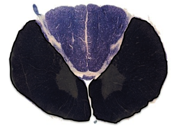 <p>a lesion in the black area would cause what type of lesion?</p>