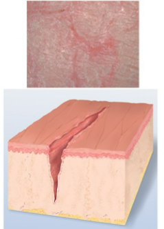 <p>linear crack w/ abrupt edges extending into dermis</p>