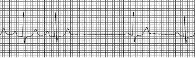 <p>SA node fails to initiate an impulse</p><p>Usually only for one cardiac cycle</p>