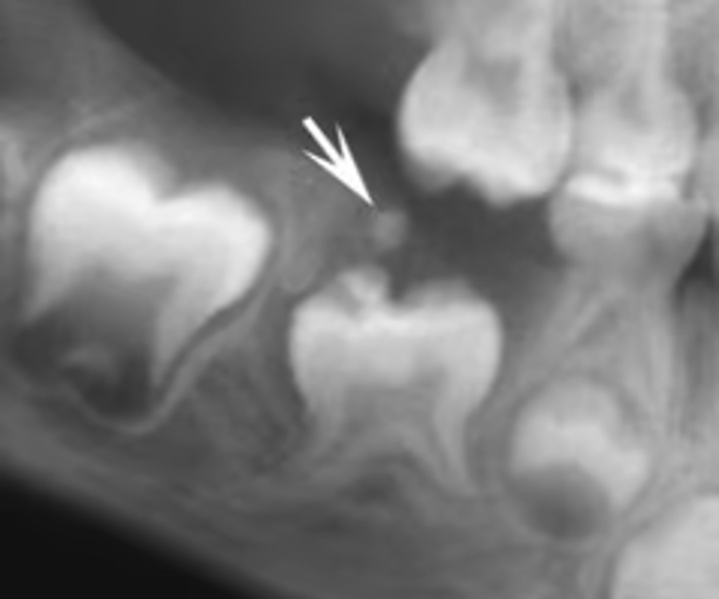 <p>What is the diagnosis?</p><p>- Tumor with features of ameloblastic fibroma plus enamel and dentin</p><p>- Average age = 10</p><p>- Seen most often in posterior, especially mandible</p><p>- Asymptomatic</p><p>- Often associated with an unerupted tooth</p>